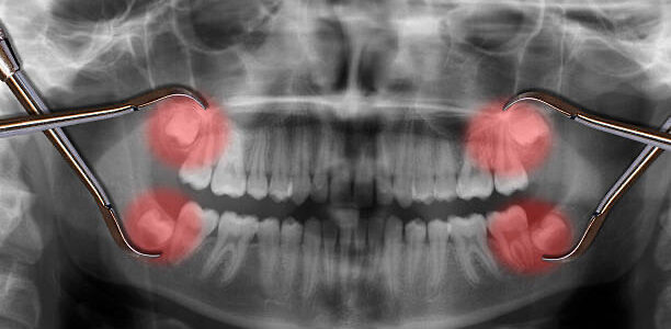 Wisdom Teeth Removal Adelaide The Costs of Wisdom Teeth Removal in Adelaide – What You Should Know Wisdom Teeth Removal Adelaide