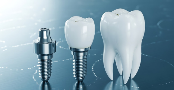 dental implants Adelaide